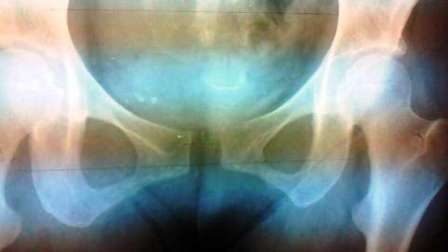 レントゲン骨盤の歪み