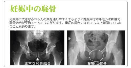 妊娠中の恥骨 レントゲン骨盤のゆるみ開き