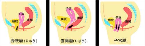 @膀胱脱(膀胱瘤)A直腸脱(直腸瘤)B子宮脱