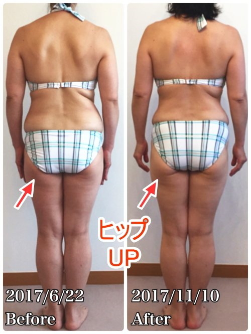 骨盤臓器脱がベルト装着で完全に治り、スタイルも良くなった!正面姿