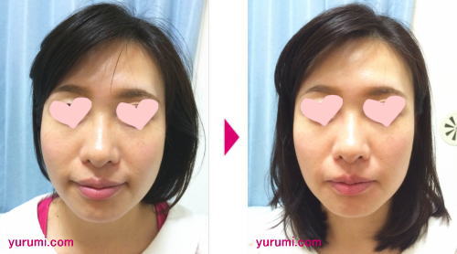 エラ張り矯正・小顔矯正ビフォーjpg